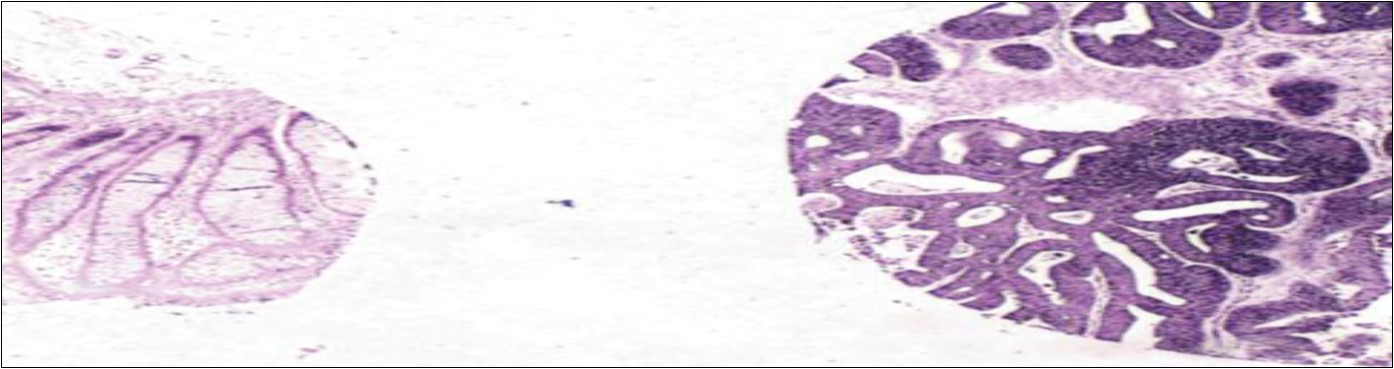 Differential expression of miR-21 in colon cancer versus the adjacent normal tissue. In situ hybridization analysis for miR-21 in this core tissue microarray sample showed very high expression in the cytoplasm of cancer dells (right part of the image) and very low expression in the adjacent normal colonic tissue epithelia (left part of image). The signal is blue due to nitroblue tetrazolium and                bromochlorindol phosphate and counterstaining with nuclear fast red, x10 67.