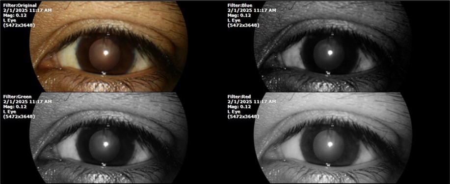 Mirror reflection of the eye on the left side, undisturbed.