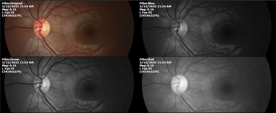 The eye that was not affected by the trauma (left side) remains in good condition.