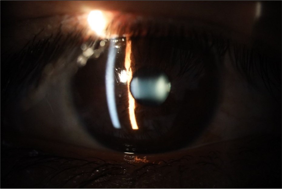 The macrograph of the anterior segment of the right eye (affected) shows very good transparency of the cornea, anterior chamber, lens, and vitreous.