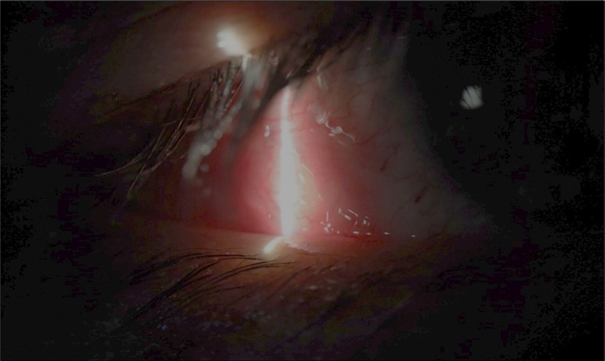 Slit-lamp examination showed a solution of continuity in the left temporal region, which fortunately only affected the conjunctiva and Tenon's capsule, while the sclera was unscathed.