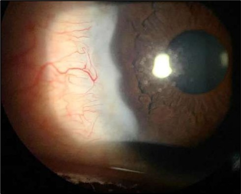 Six-month follow-up image showing a stable ocular surface, and absence of ulcer recurrence. The cornea appears clear centrally, with stromal scarring limited to the periphery.
