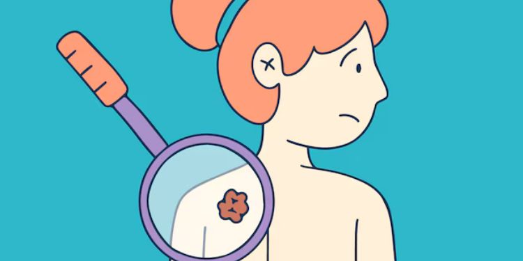 Journal of Skin Cancer Epidemiology - skin basal cell carcinoma